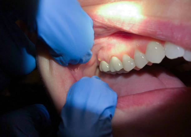 Best Broken or Chipped Tooth Repair in Maxton, NC
